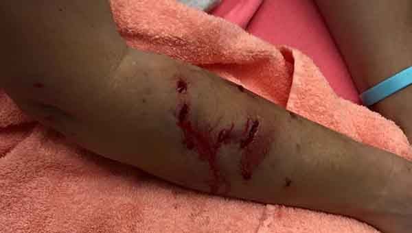 Monday's attack by a rabid bobcat left Michelle Russell with deep gashes in her right arm.  SUBMITTED PHOTO